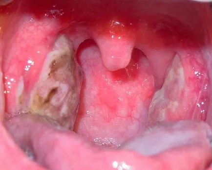 Бактериалната тонзилит (ангина) причини, симптоми, лечение