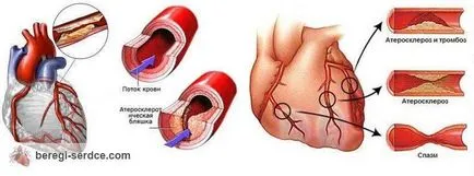 Angina mai periculoase, complicații cardiace de angină pectorală, comportamentul pacientului