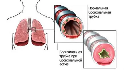 Asthma bronchiale, hogy a fertőző