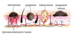 Ceea ce este diferit de negii papilloma - diferente in cauzele, tratamentul