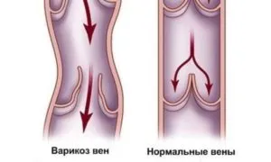 Mennyire veszélyes, hogyan kell kezelni a visszerek a lábát a férfiak - venopedia