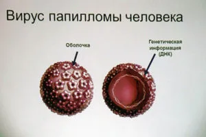 Ceea ce este diferit de negii papilloma - diferente in cauzele, tratamentul