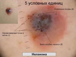 Ceea ce este diferit de negii papilloma - diferente in cauzele, tratamentul