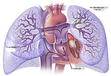 A veszélyes pulmonális hipertenzió újszülöttek és hogyan kell kezelni