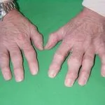 Arthritis deformans fenyeget helyrehozhatatlan következményei