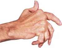 deformáló arthritis