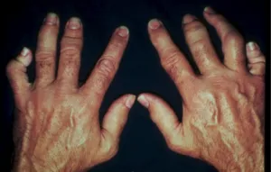 Deformând artrita a degetelor, articulațiilor, semne și simptome, medicamente și