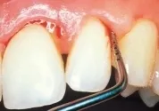 Diagnosztizálására és kezelésére periodontitis arzén