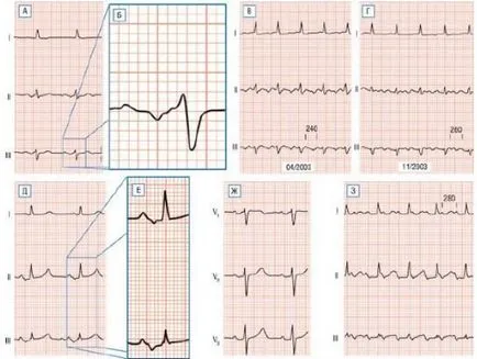 Diagnosticul de tahicardie supraventriculară