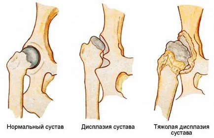 Hip dysplasia okai és kezelése a betegség