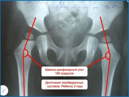 Hip dysplasia okai és kezelése a betegség