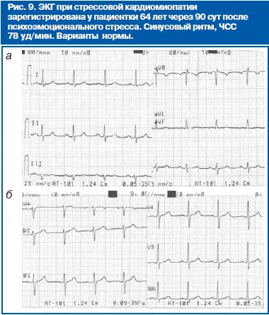 EKG cardiomyopátiák különböző etiológiájú - referencia járóbeteg orvos №04 2012 - consiliumhoz