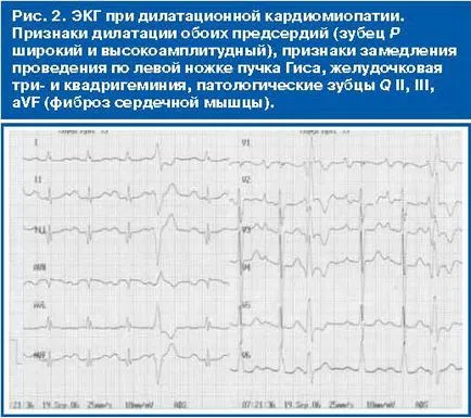 EKG cardiomyopátiák különböző etiológiájú - referencia járóbeteg orvos №04 2012 - consiliumhoz
