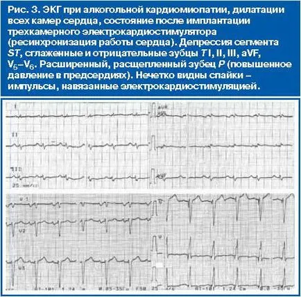 EKG cardiomyopátiák különböző etiológiájú - referencia járóbeteg orvos №04 2012 - consiliumhoz