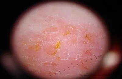 Eczema nu este contagioasa si se transmite la sau de la o persoană la alta