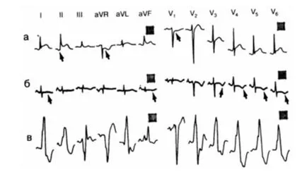 Fireaid elektrokardiogram - EKG kóros szívizomgyulladás, szívburokgyulladás, kardiomiopátia