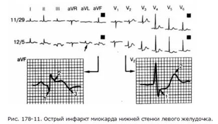 electrocardiogramă Fireaid - ECG patologii miocardita, pericardita, cardiomiopatie