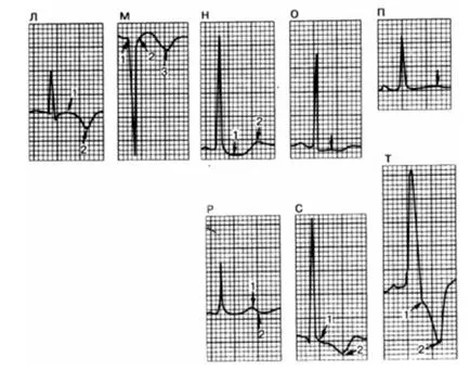 Fireaid elektrokardiogram - EKG kóros szívizomgyulladás, szívburokgyulladás, kardiomiopátia