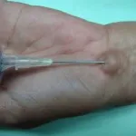 Higroma tratament încheietura mâinii fără fotografii de chirurgie