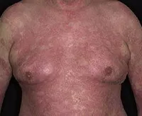 Általános göbös psoriasis - okai, tünetei, diagnózisa és kezelése