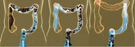 Колон хидротерапия - дълбоко почистване на дебелото черво