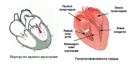 Hipertrofiei atriul drept