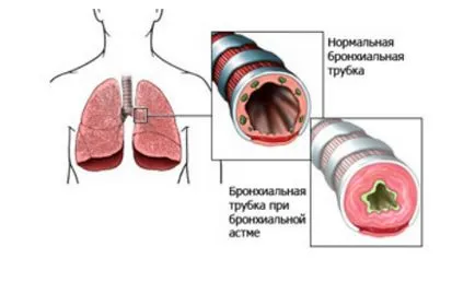 Hipertrofiei atriul drept