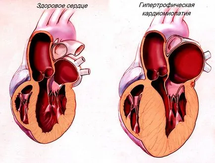 Hipertrófiás kardiomiopátia okok, tünetek, kezelés
