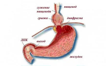 Hiatus hernia tünetei, kezelése, diéta