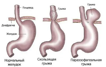 Хиатална херния, отколкото опасно