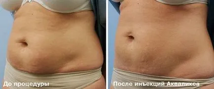 Liposucție Injection (lipoliza) - Ce este, comentarii, preturi, fotografii înainte și după