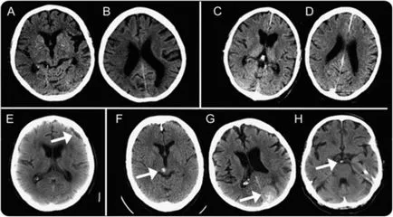 Milyen gyakran lehet csinálni egy agyi MRI, a következmények a fej tomográfia