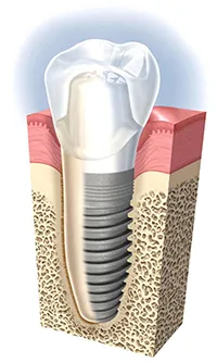 Mi a jobb fogászati ​​implantátumok