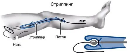 Cum pentru tratarea venelor varicoase pe picioarele oamenilor de revizuire a metodelor moderne