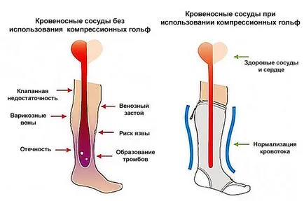 Cum pentru tratarea venelor varicoase pe picioarele oamenilor de revizuire a metodelor moderne