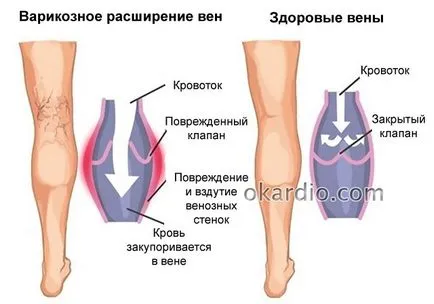 Cum pentru tratarea venelor varicoase pe picioarele oamenilor de revizuire a metodelor moderne