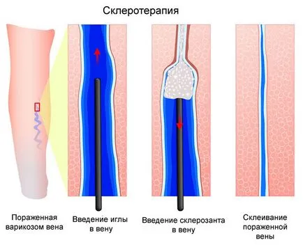 Cum pentru tratarea venelor varicoase pe picioarele oamenilor de revizuire a metodelor moderne