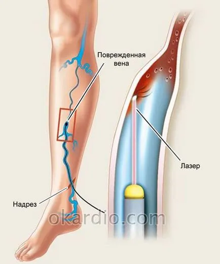 Cum pentru tratarea venelor varicoase pe picioarele oamenilor de revizuire a metodelor moderne