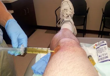 Cum de a pompa fluidul din articulația genunchiului, elimina excesul de lichid din genunchi