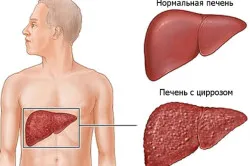 Цироза предава наследствеността, паразити, вируси