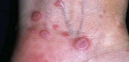 Ce este Impetigo la om - fotografii, semne, simptome si tratamentul diferitelor tipuri de privarea unei persoane, ina