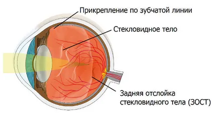 Care este desprinderea ochiului vitros