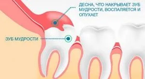 Hood pe dinte înțelepciune și îndepărtarea acestuia în timpul inflamației