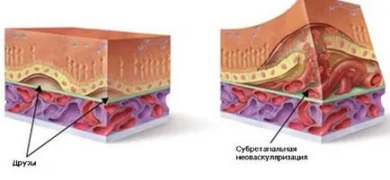 A karotinoidok a kezelés időskori makula degeneráció a retina - Causes, tünetek és kezelés