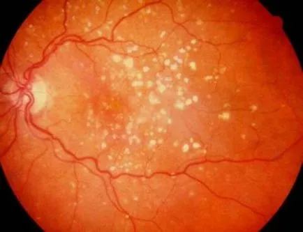 A karotinoidok a kezelés időskori makula degeneráció a retina - Causes, tünetek és kezelés