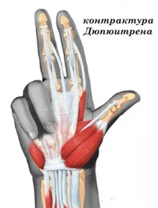 четка контрактура диагностика, консервативно и хирургично лечение