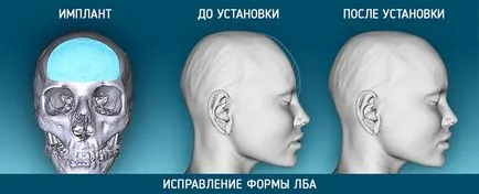 Cranioplasty, 3d műanyag (új szépségben sebészet)