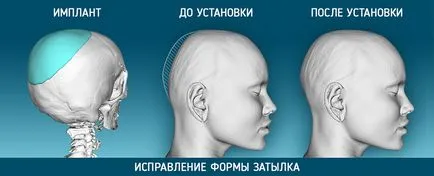 Cranioplasty, 3d műanyag (új szépségben sebészet)