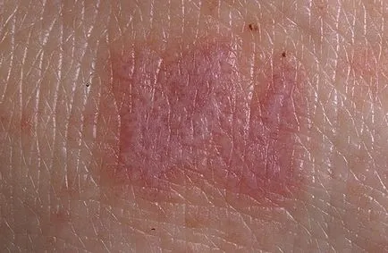 lichenul cutanat Rosu - arata ca, cauze, simptome și tratament