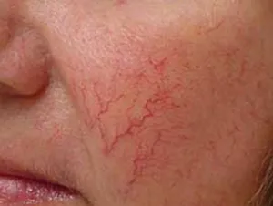 Elleni krém rosacea az arc a terápiás elvek és eredmények